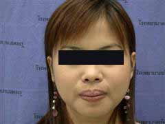 Mandible Angle Reduction Thailand